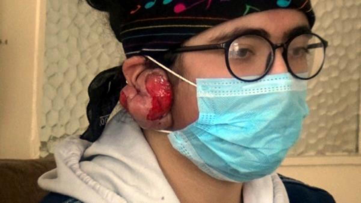 Kulaklarında keloid oluşan Yağmur, tedavi olamazsa duyamayacak