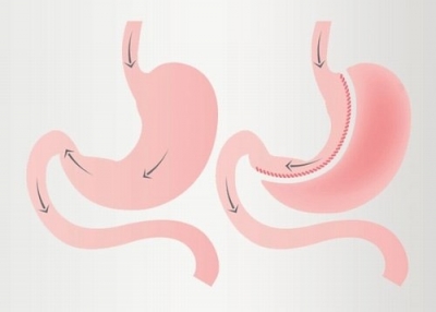 Sağlıklı Bir Geleceğe Adım Atarken Obezite Ameliyatı Süreci